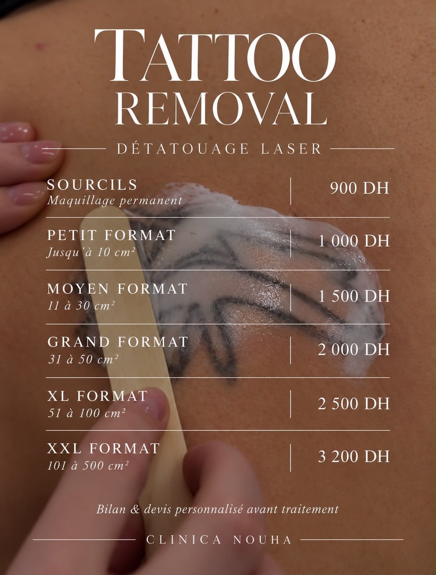 Tattoo Removal - Détatouage laser